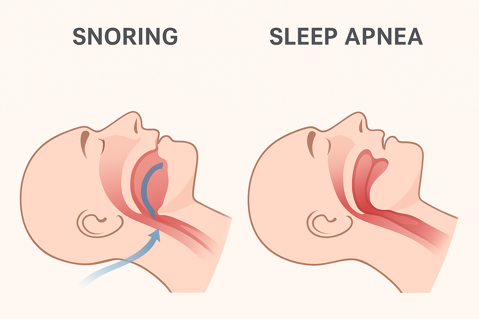 Sleep Apnea